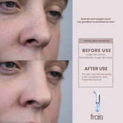 FRAIS Vaccum Blackhead Remover