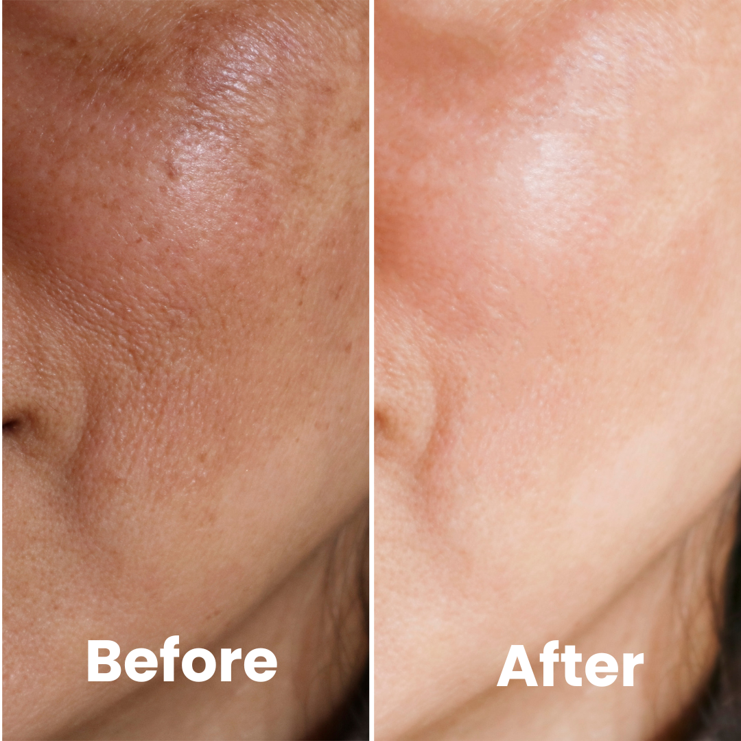 FRAIS Microdermabrasion Facial Rolle