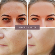 FRAIS Microdermabrasion Facial Rolle